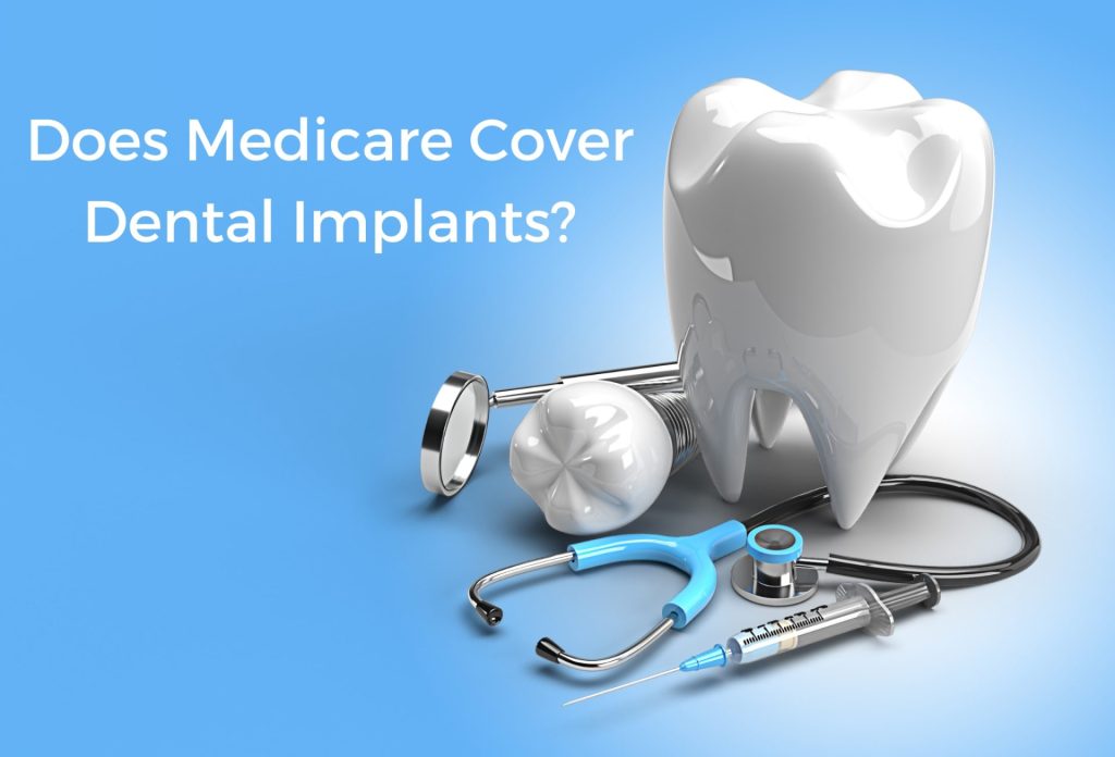 Medicare Dental Implants